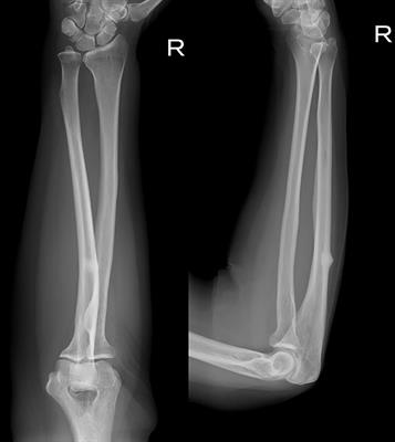 Case Report: Prophylactic Plate Fixation for Incomplete Atypical Ulnar Fractures Resulting From the Use of Denosumab for Bone Metastases